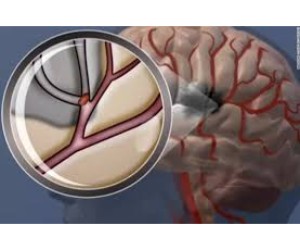 Acute Ischemic Stroke Therapeutics