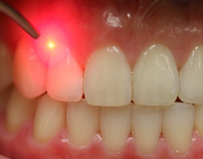 Dental Lasers