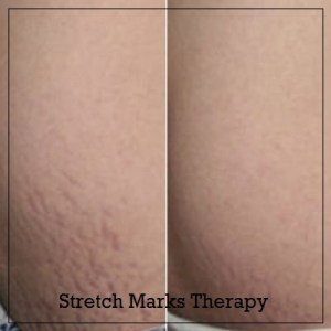 Stretch Marks Therapy