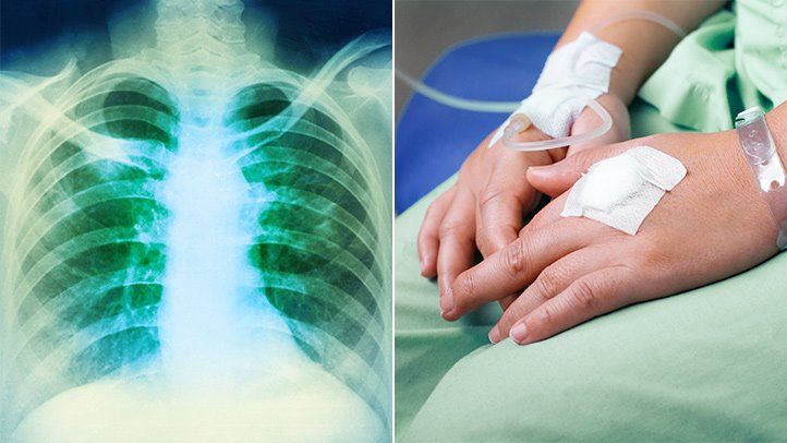 Hodgkin Lymphoma Treatment