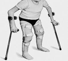 osteogenesis-imperfecta-treatment