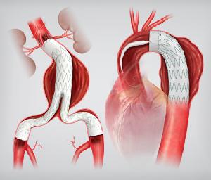 stent-grafts