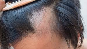 alopecia