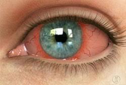 anterior-uveitis