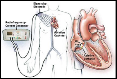 Cardiac Ablation
