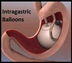 Intragastric Balloons