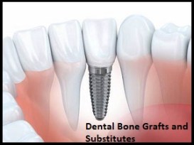 Dental Bone Grafts and Substitutes