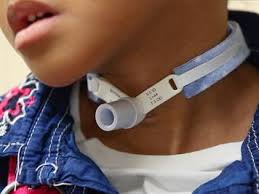 Tracheostomy