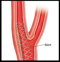Carotid Stent