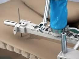 Spine Surgical Robots