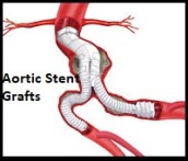 Aortic Stent Grafts