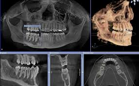 Dental CBCT