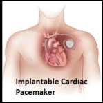 Implantable Cardiac Pacemaker