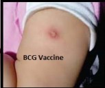 BCG Vaccine