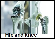 Hip and Knee Replacement