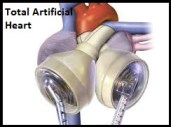 Total Artificial Heart