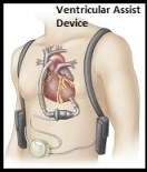 Ventricular Assist Device
