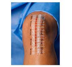 Surgical Incision Closure Devices Market Report Expected Massive Growth By 2021-2026 | Ethicon, Welfare, Medline,&nbsp;Medtronic