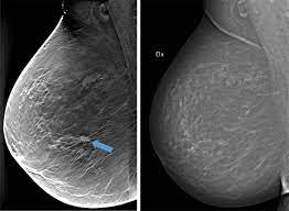 Breast Imaging Market Study By Type, Applications & Top Manufacturers – Siemens, Macroo, Perlong Medical,&nbsp;Philips