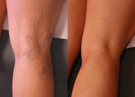 Sclerotherapy Market Report Expected Massive Growth By 2021-2026 | BTG, Angiodynamics, Troikaa,&nbsp;Kreussler