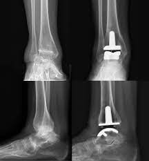 Total Ankle Replacement Market Study By Type, Applications & Top Manufacturers – Integra LifeSciences Corporation, Zimmer, Wright Medical Technology,&nbsp;Inc