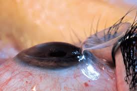 LASIK Surgery Market Report 2022-2028 Product Scope & Top Manufacturers – Johnson & Johnson, Novartis, Bausch Health, Carl&nbsp;Zeiss